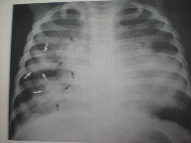 Anchetă epidemiologică: Posibil focar de TBC la o grădiniță