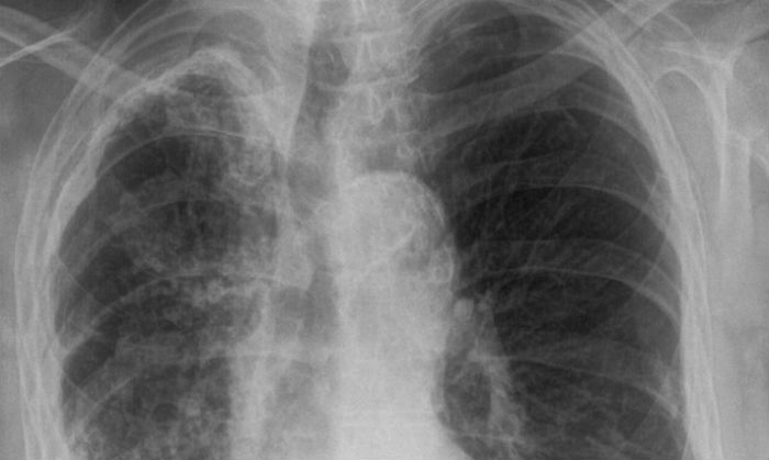 Alertă la o școală din Galați: O profesoară a fost diagnosticată cu tuberculoză