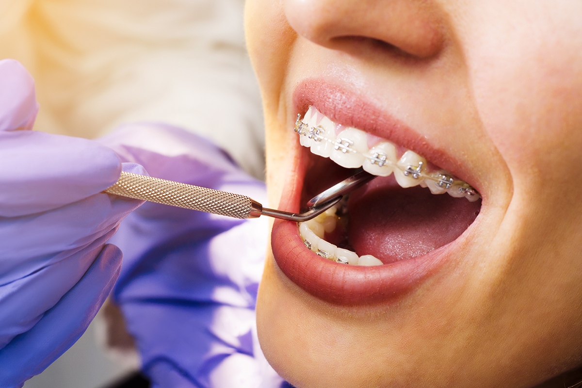 Apratul dentar este foarte eficient pentru o bună sănătate orală