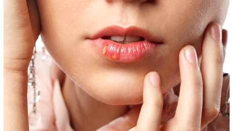 Herpesul se poate lua prin sărut, în cazul în care una dintre persoane are infecția