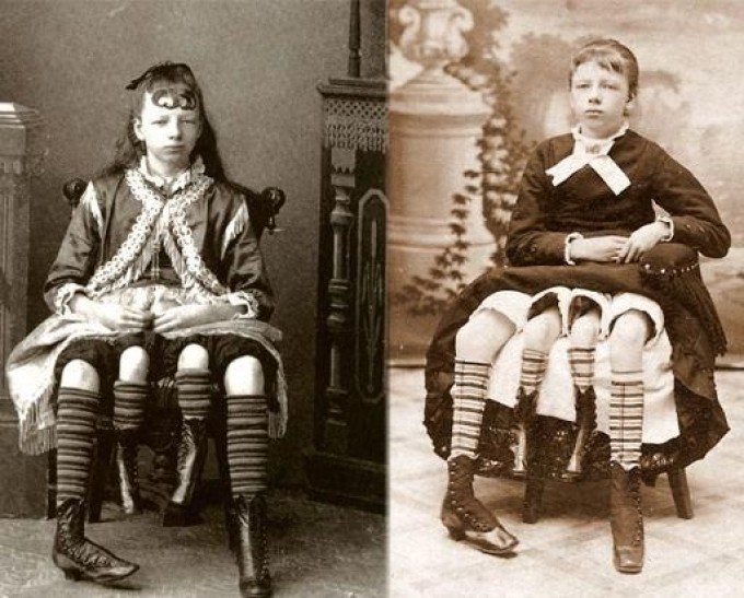 Cazul care a uimit lumea medicală: Myrtle Corbin, femeia cu patru picioare. Ce s-a ales de ea