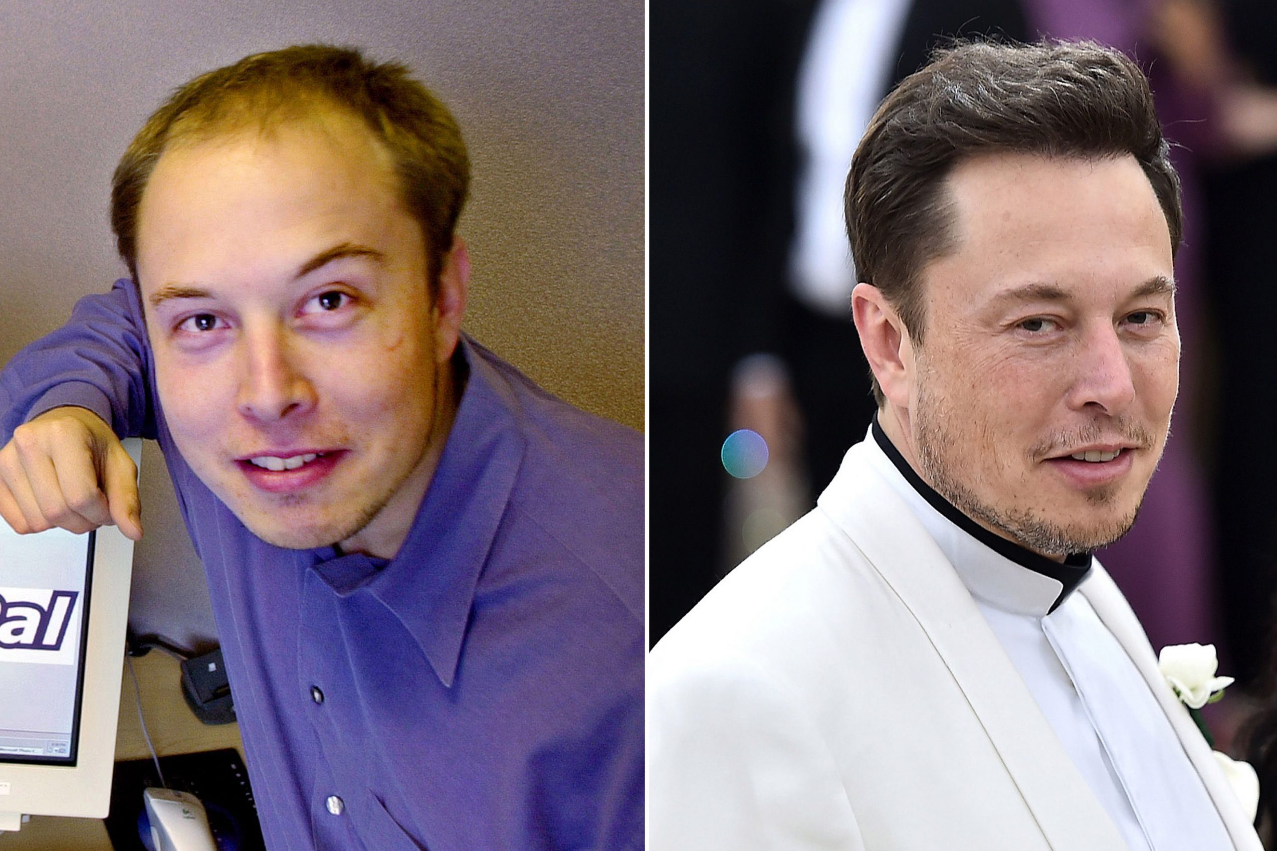 Vedete care și-au făcut implant de păr. Elon Musk