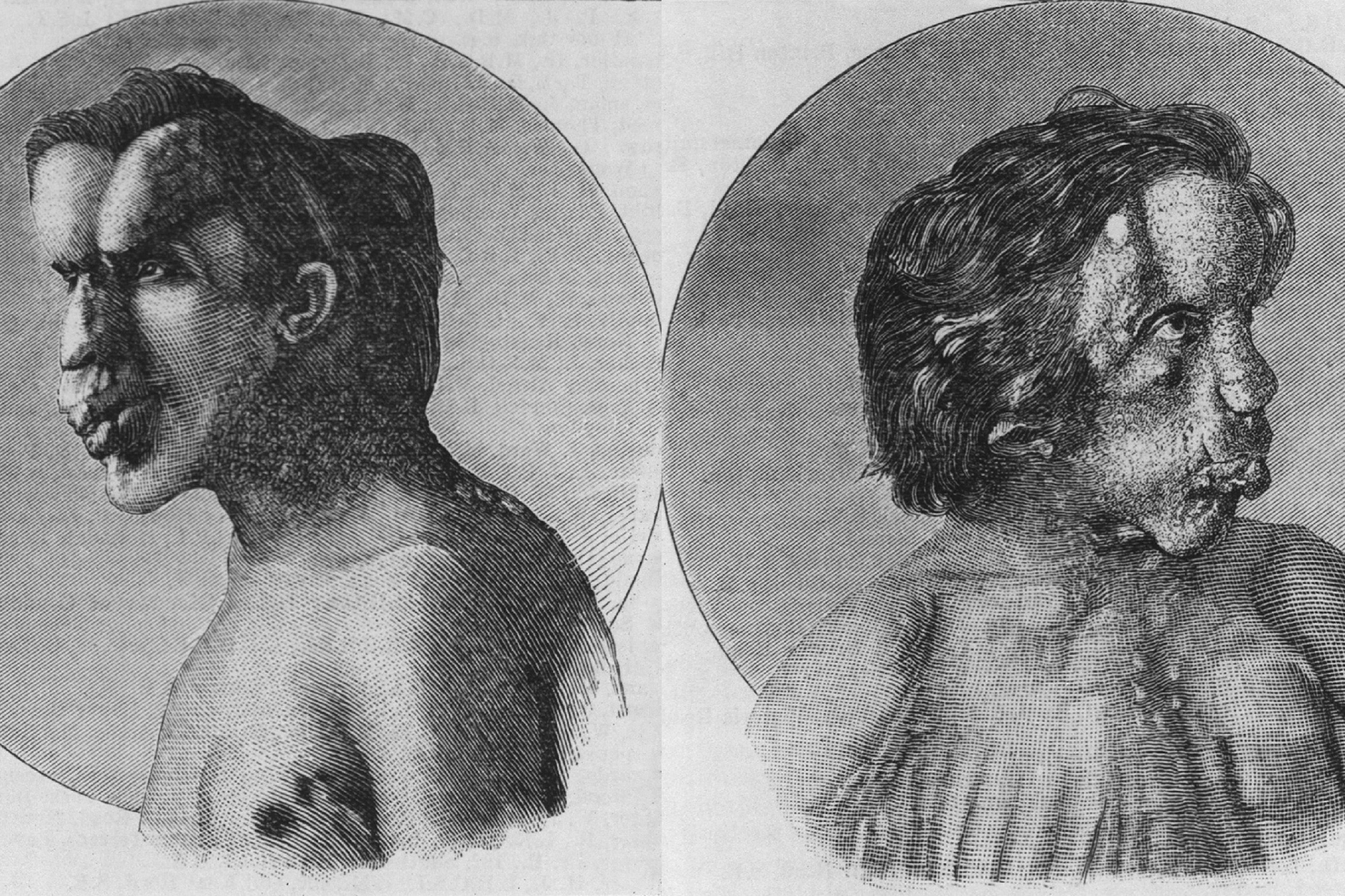 Povestea tragică a lui Joseph Merrick, omul-elefant. Cum a ajuns el să arate așa