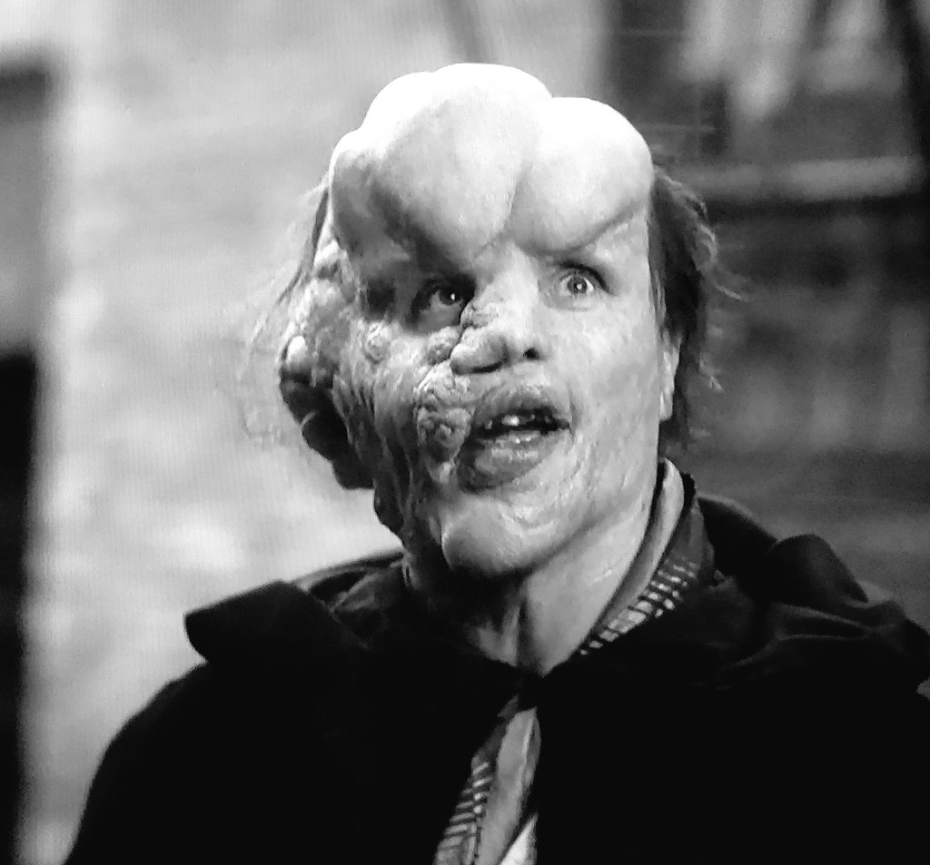 Joseph Merrick, omul-elefant