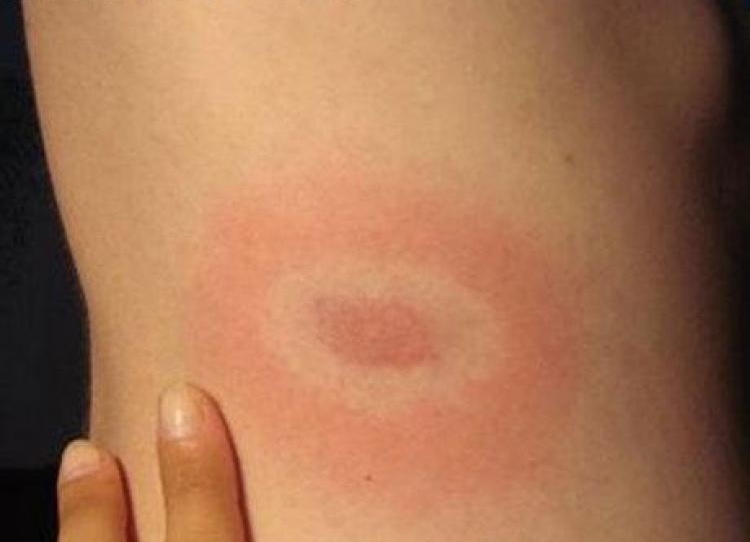 Ce este boala Lyme și cum se transmite