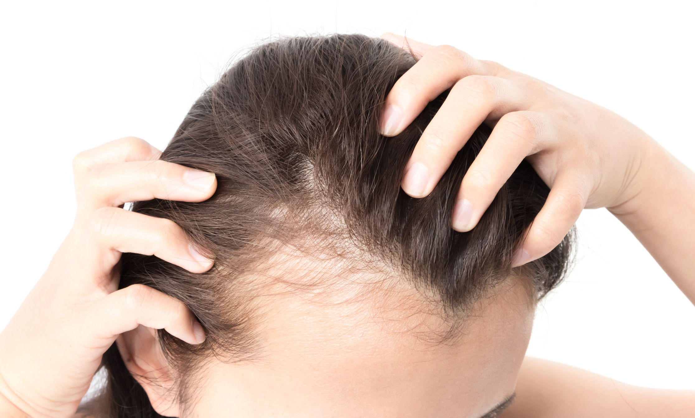 Alopecia androgenică