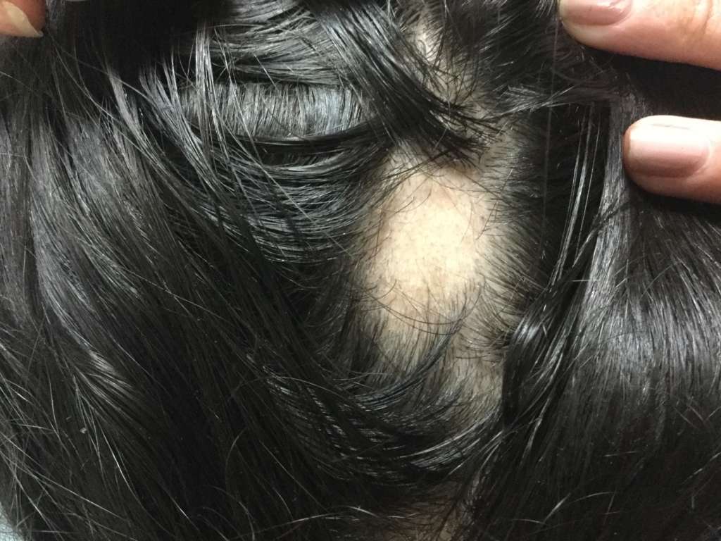 Alopecia areată