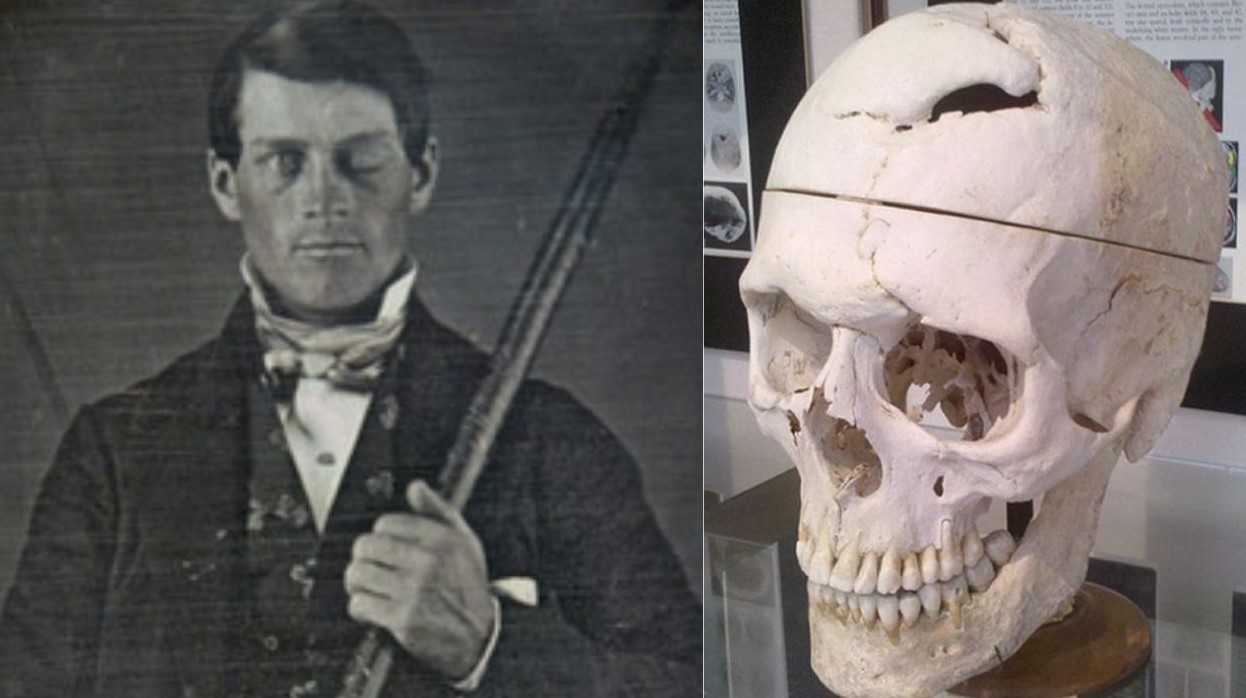 Bărbatul care a supraviețuit, după ce o bară de metal i-a trecut prin craniu. Cum i-a schimbat viața accidentul dramatic