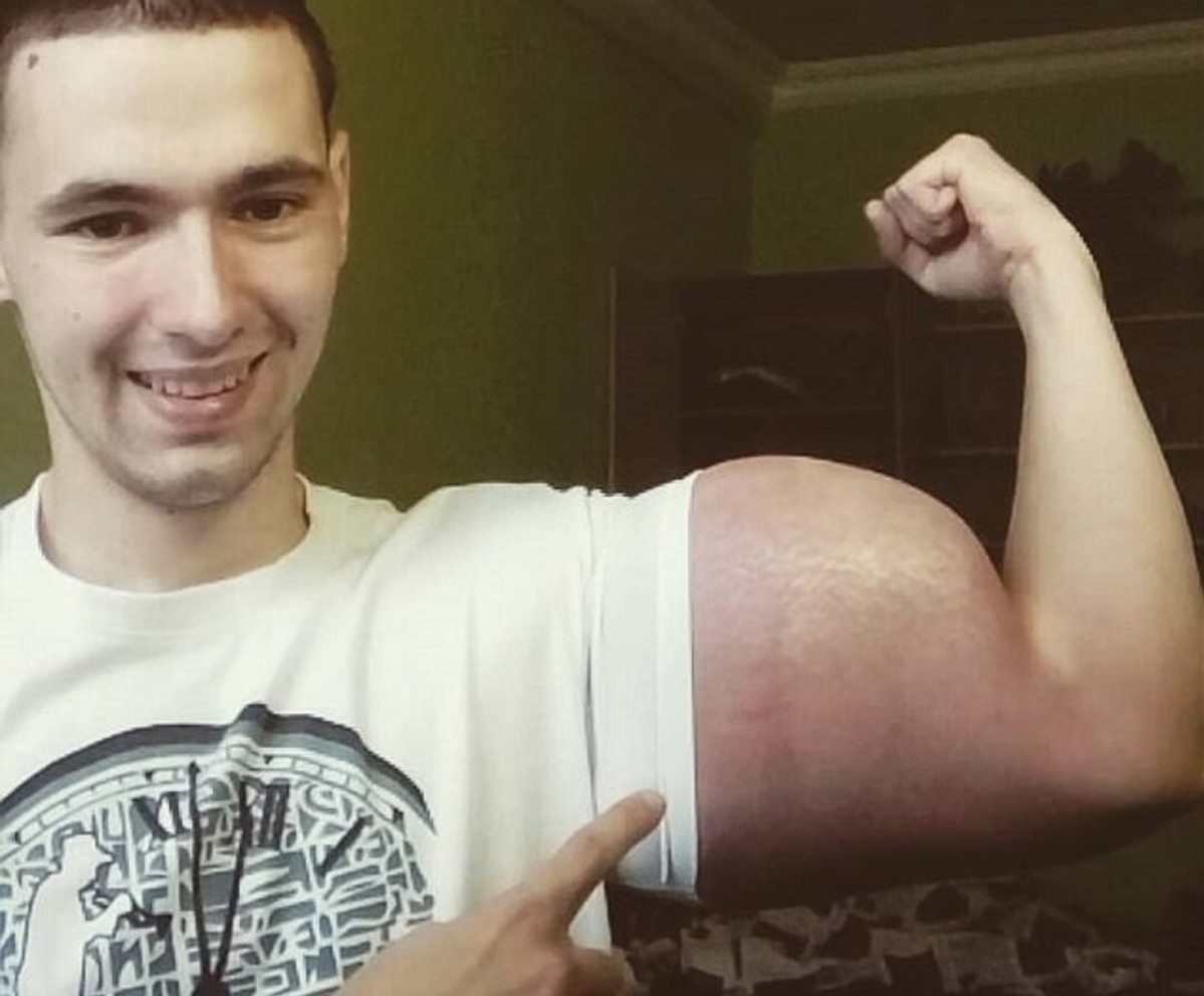Rusul care și-a injectat ulei în brațe. Cum a ajuns să arate