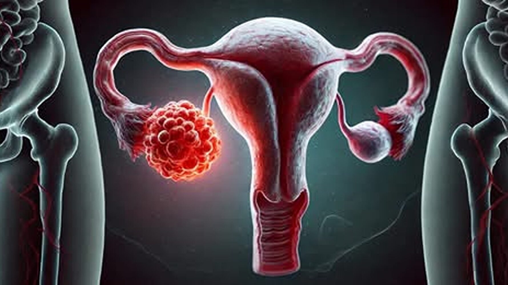 Deși se poate depista facil, cancerul ovarian continuă să fie diagnosticat în stadii avansate